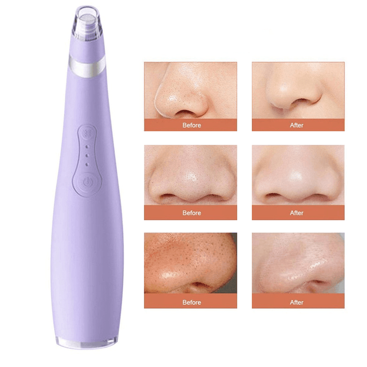 Ultra Pore Vacuum – Deep Cleansing Blackhead and Pore Removal